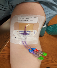 PICC line inserted by specialized team at Henry Ford Hospital's hematology-oncology unit, where bloodstream infections have dropped by 75 percent in one year.