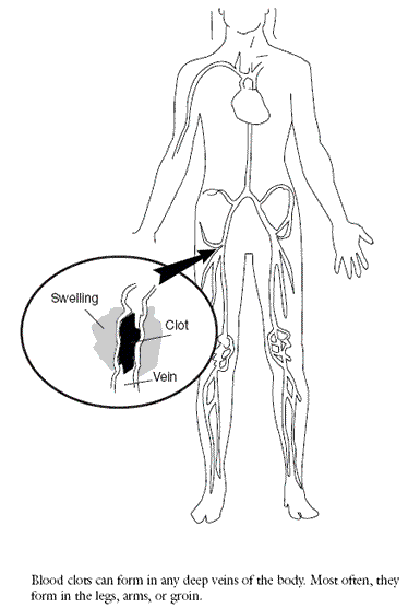 La figura 1 proporciona una ilustración de un coágulo de sangre en la pierna.