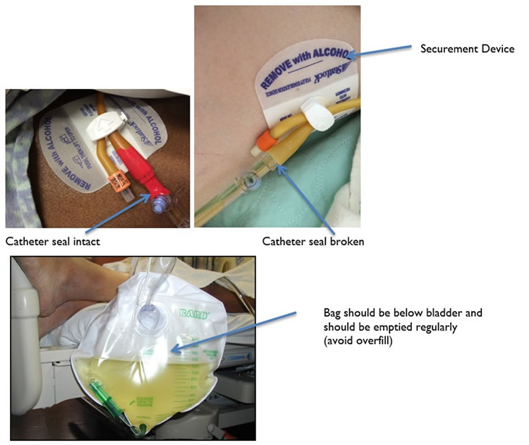Three images: Catheter seal intact Catheter seal broken; securement device Bag should be below bladder and should be empied regularly (avoid overfill)
